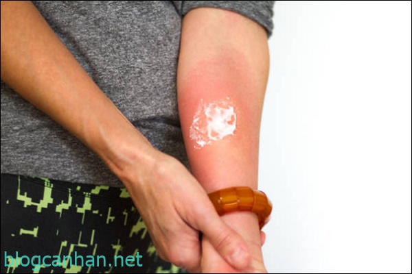 Baking soda làm dịu vết công trùng cắn